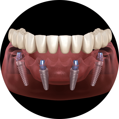 full arch dental implants 2