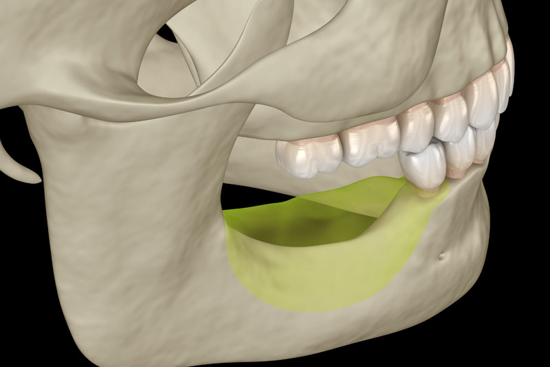 Rendering of jaw bone loss