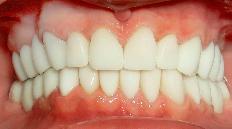 A Clean Jaw of an Adult With Proper Teeth Alignment