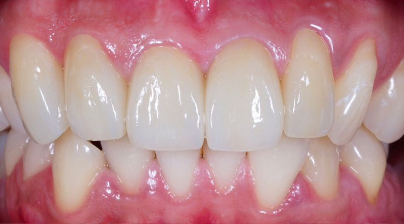 A Fixed Teeth of a Dental Implant