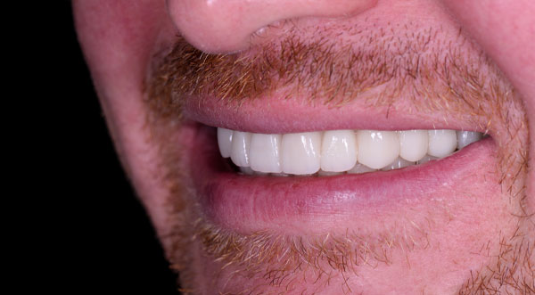 The Teeth of a Man After Getting Dental Implants