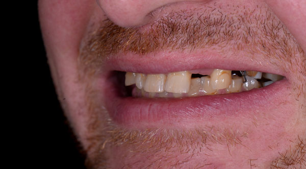 The Teeth of a Man Before Getting Dental Implants
