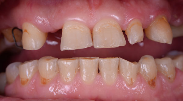 A Missing Disoriented Teeth of a Jaw